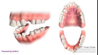 4 First Premolar Extraction for Retraction  Orthodontic Treatment [upl. by Idoj]