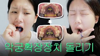 성인교정 🔧 악궁확장장치 돌리는 영상 모음zip 😬 비포amp애프터까지 보여드립니다 [upl. by Montfort600]