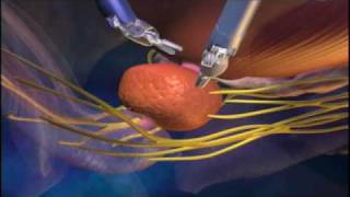 Robot Da Vinci Prostatectomia  Urologia Savona  wwwurologiasavonait [upl. by Fenella]