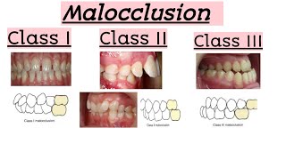 malocclusionsClass IClass IIClass IIIClinical featuresQuick Revision [upl. by Arracat211]