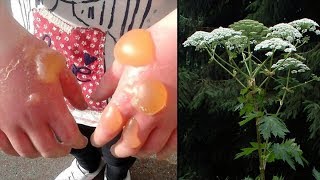 Giant Hogweed  A FleshBurning Plant Explained [upl. by Ednew]