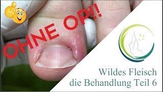 Wildes Fleisch die Behandlung Teil 6 podologinandrea [upl. by Haidedej27]