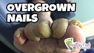 Overgrown Toe Nails [upl. by Ocirled]