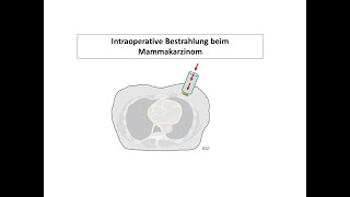 Intraoperative Bestrahlung beim Mammakarzinom  Strahlentherapie Prof Hilke Vorwerk [upl. by Ralat302]