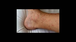 Hives healthcare disease health [upl. by Sherer]