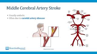 Neurology Step 23 — Stroke II — Boards and Beyond [upl. by Dolloff]