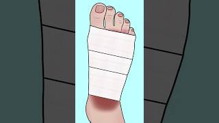 ASMR Remove isopod parasite from infected foot P2 asmr animation satisfying viralvideo shorts [upl. by Bashemath311]