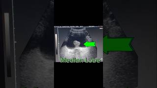 Prostatomegaly  Enlarged Prostate  Median Lobe  Urine Retention on Ultrasound [upl. by Placida]