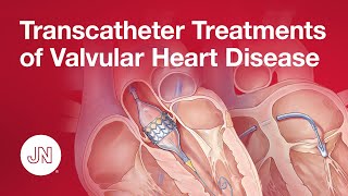 Transcatheter Treatments of Valvular Heart Disease [upl. by Ias]