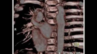 Cardiac prior repair of a coarctation of the aorta 7 of 7 [upl. by Jude]