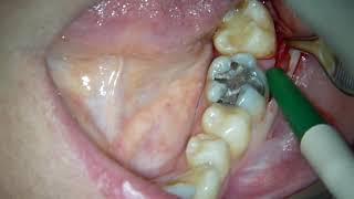 flap design in 3d molar extraction [upl. by Sukramaj]