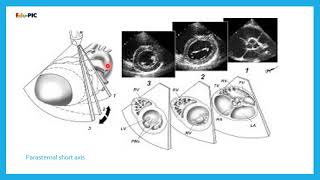 Paediatric Echocardiography POCUS Approach [upl. by Netfa]