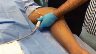 Supine popliteal block a new simple ultrasound guided technique [upl. by Suaeddaht]