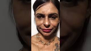 Melasma com o profissional certo o resultado vem melasma melasmatreatment bioestimuladores [upl. by Olivie]