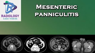 Mesenteric panniculitis [upl. by Therese]