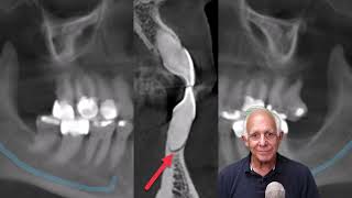 3 Top Factors for Deciding When to Extract a Tooth in 2024 [upl. by Simpson]