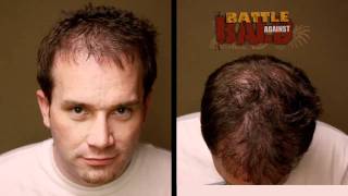 Hair Transplant Results  12 Month Timelapse Before and After  Bosley Medical [upl. by Stoddard]