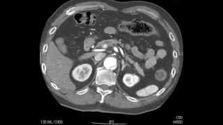 Aortic Dissection  QMH AED Ultrasound Casebook 201409 Video 7 [upl. by Adnahcir]