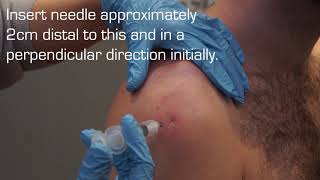 Injection Technique into the Subacromial Space for Rotator Cuff Related Shoulder Pain [upl. by Aihpled]