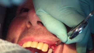 Préparation et pose dun implant dentaire partie 2 de 3 JMM DENTAL IMPLANT [upl. by Mohamed]