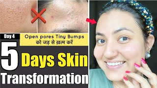 5 DAYS SKIN TRANSFORMATION CHALLENGE  Remove Tiny Bumps Open PoresClogged Pores in 5 Days [upl. by Eelloh]