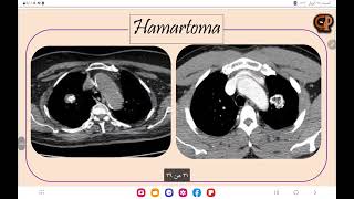 3 Lung Lesions  tuberculoma vs Hamartoma [upl. by Ekusoyr]