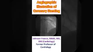 Angiographic Illustration of Coronary Stenting [upl. by Pattison]