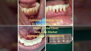 Periodontal splinting for mobile teeth [upl. by Woods]