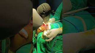 corrective osteotomy [upl. by Rivard116]