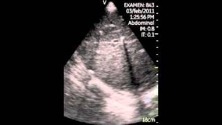 VSCAN Hepatic granulomas calcified [upl. by Mcgrath]