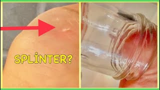 Amazing Uses of Baking Soda  REMOVE SPLINTERS amp CLEAN SHOWER HEADS [upl. by Decamp]