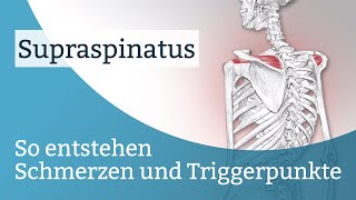 Supraspinatus Schmerzen Triggerpunkte und deren Aktivierung [upl. by Kilah]