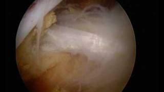 UK Surgeon  wwwshouldersurgeryorguk  Arthroscopic Suprascapular nerve decompression [upl. by Biancha]