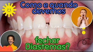 Quando e como fechar diastemas em incisivos superiores anteriores na dentição mista  Aula 144 [upl. by Atirrehs]