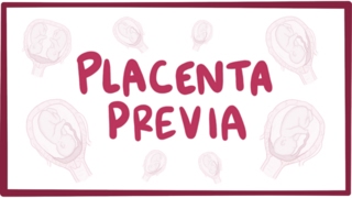 Placenta previa  causes symptoms diagnosis treatment pathology [upl. by Amis]