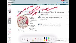 Cingulate herniation neurology 148  First Aid USMLE Step 1 in UrduHindi [upl. by Winter]