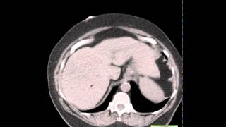 CT Epiploic Appendagitis [upl. by Uriia]