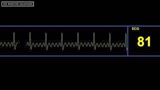 Aflutter Waveform  Simulated Patient Waveform [upl. by Poore886]