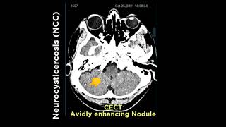 Neuro cysticercosis NCC [upl. by Damha]