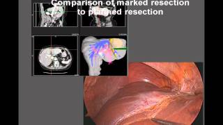 ImageGuided Laparoscopic Liver Resection [upl. by Adnana]