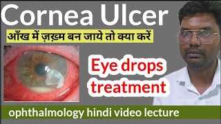 cornea ulcer treatment  cornea foreign body  corneal ulcer treatment  cornea ulcer eye drops [upl. by Aiyn]