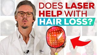 Laser Treatment For Hair Loss And Hair Regrowth Does It Work QampA [upl. by Kella]