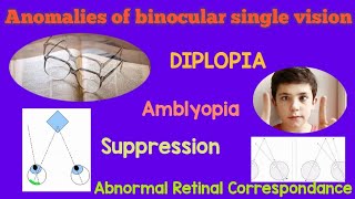 Binocular vision  Binocular single vision  Anomalies of binocular single vision  Cause behind BSV [upl. by Alyss]