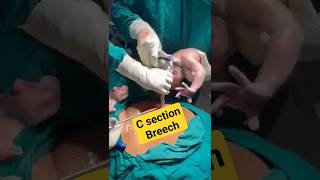 c sectionbreech deliverybaby birthshortsvideo [upl. by Yerfoeg205]