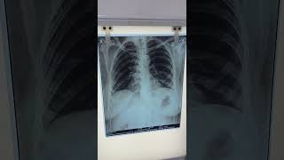 Xray chest PA Posteroanterior View is an imagine test that uses Xrayimagine heart lung chest 🫁 [upl. by Cimah908]