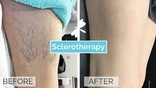 Sclerotherapy Leg Vein Treatment  The Laser and Skin Clinic [upl. by Janean495]