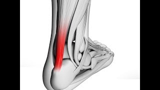 What is Achilles Tendonitis [upl. by Yhtimit566]