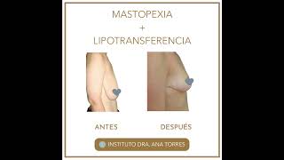 Antes y después de Mastopexia y Lipotransferencia  Instituto Dra Ana Torres Barcelona [upl. by Caraviello]