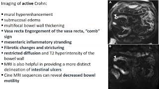 Diffusely Infiltrative Small Bowel Disease dr Sara Tawfiq [upl. by Adiehsar]