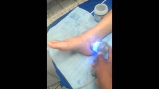 TRATAMIENTO DE LESION DE TOBILLO DE 2° GRADO CON LASER ULTRASONIDO ELECTROESTIMULACION [upl. by Hardej]